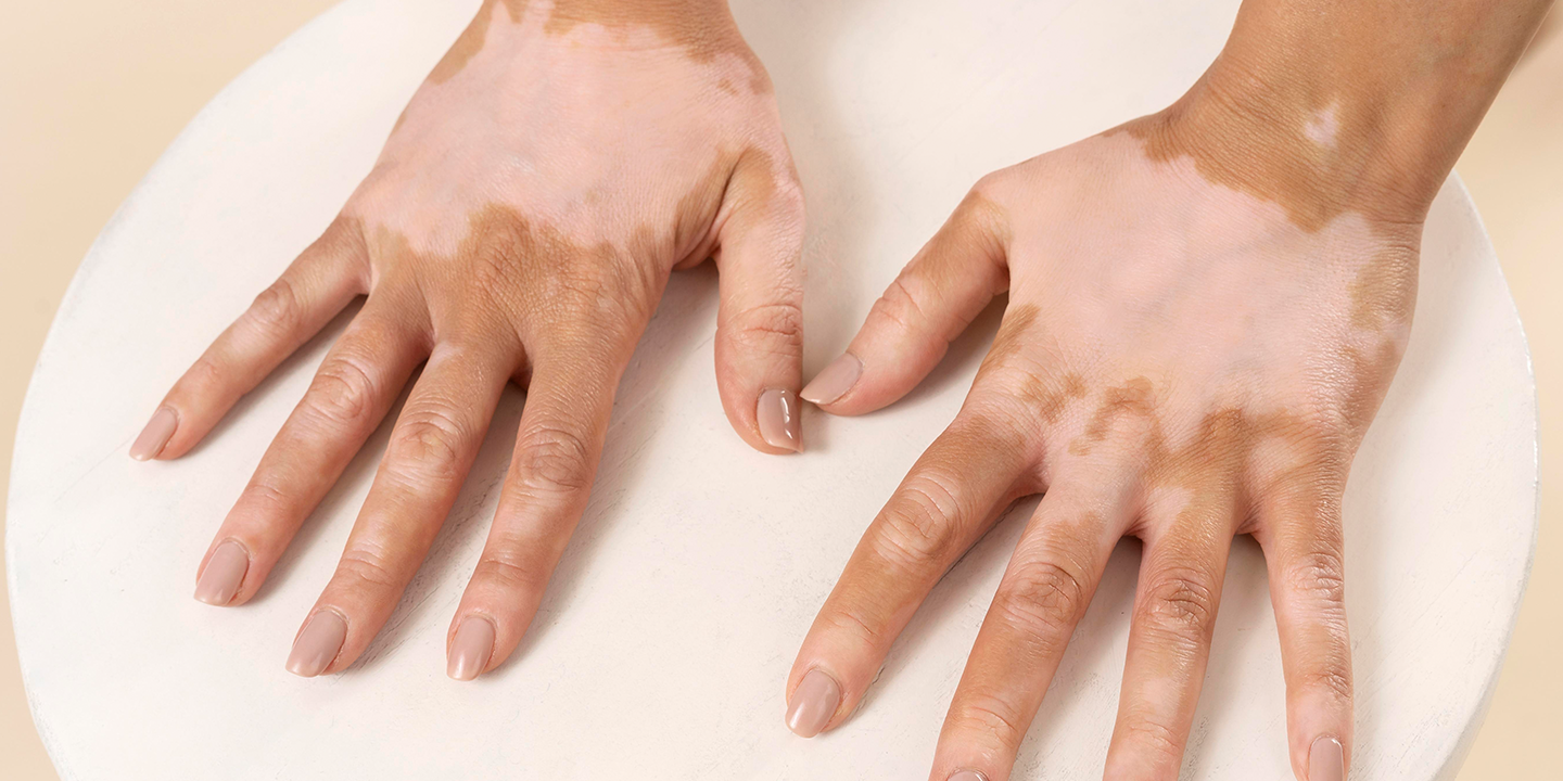 Blog post: Vitiligo Awareness in Bihar: Myths vs Facts & Modern Care